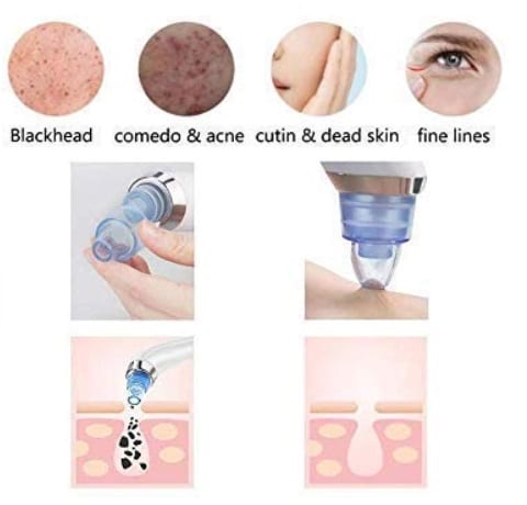 Best Blackhead Remover Vacuums